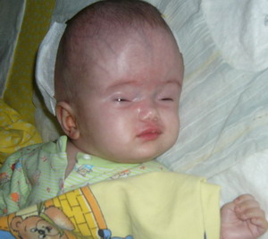 Hydrocelphalus Program Bulgaria